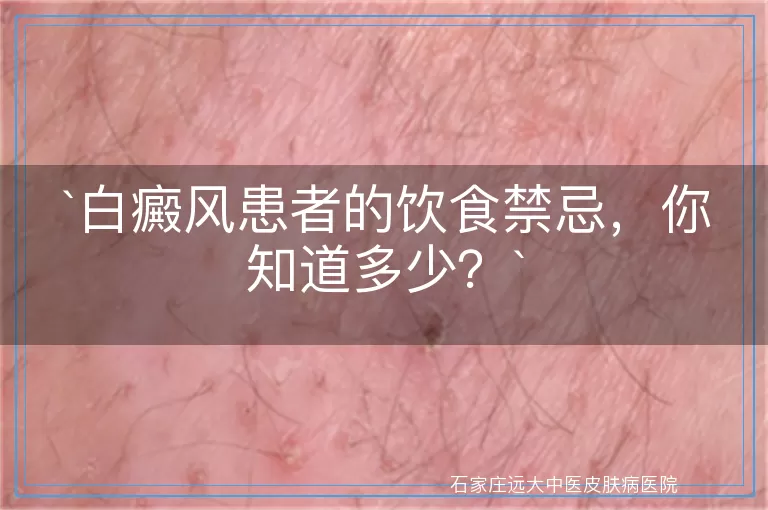 白癜风患者的饮食禁忌，你知道多少？