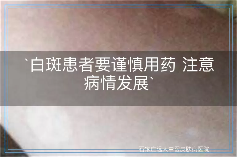 白斑患者要谨慎用药 注意病情发展