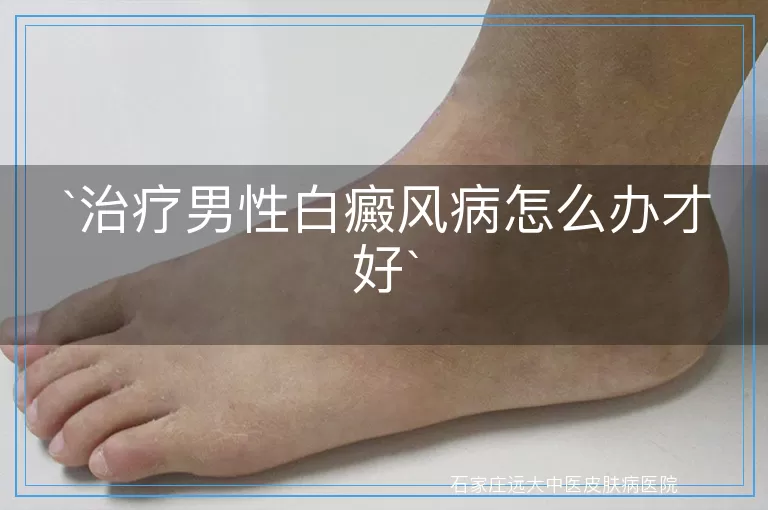 治疗男性白癜风病怎么办才好