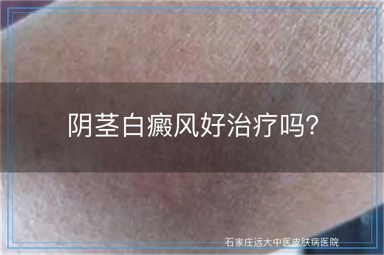 阴茎白癜风好治疗吗？