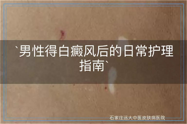 男性得白癜风后的日常护理指南