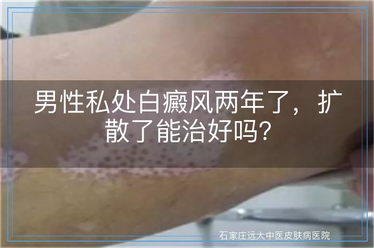 男性私处白癜风两年了，扩散了能治好吗？