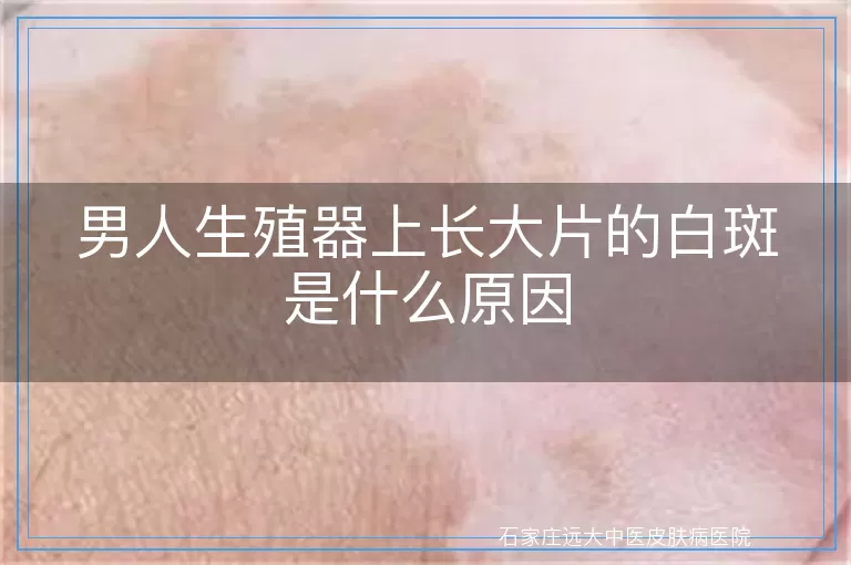 男人生殖器上长大片的白斑是什么原因