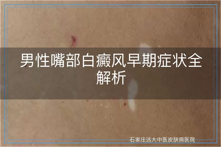 男性嘴部白癜风早期症状全解析