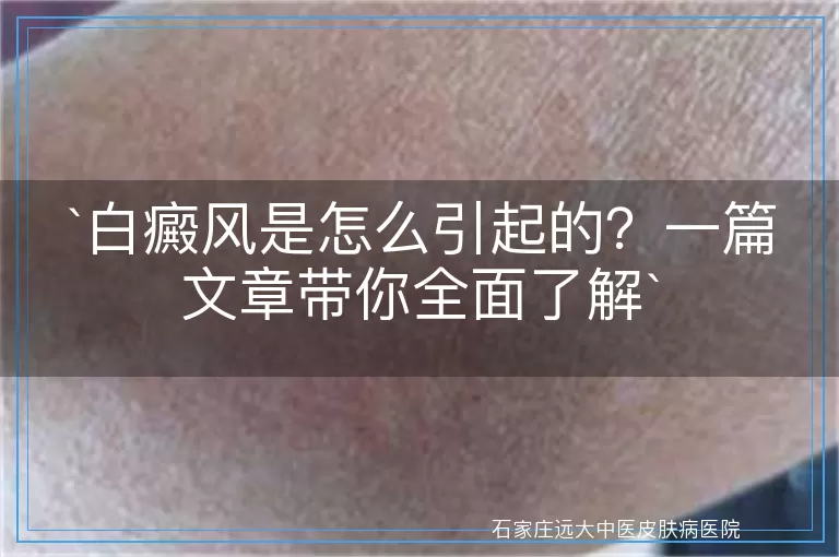 白癜风是怎么引起的？一篇文章带你全面了解