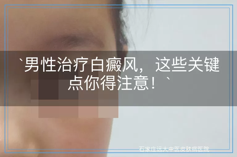 男性治疗白癜风，这些关键点你得注意！
