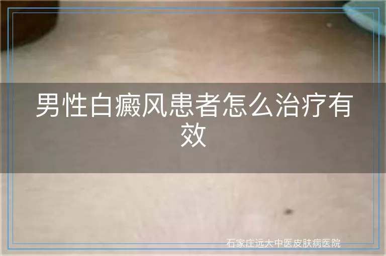 男性白癜风患者怎么治疗有效