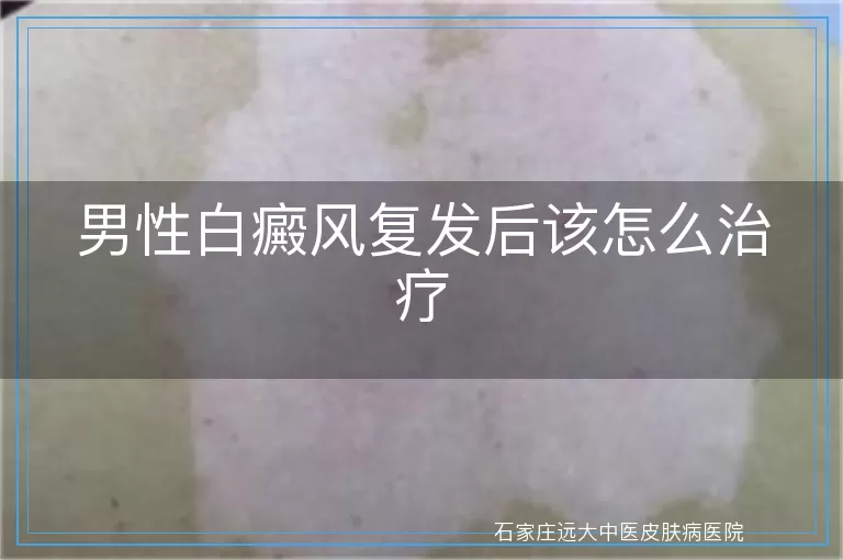 男性白癜风复发后该怎么治疗