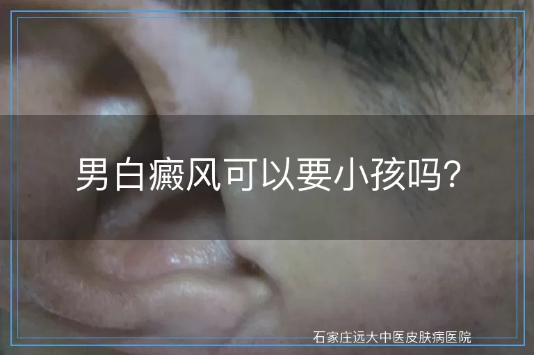 男白癜风可以要小孩吗？
