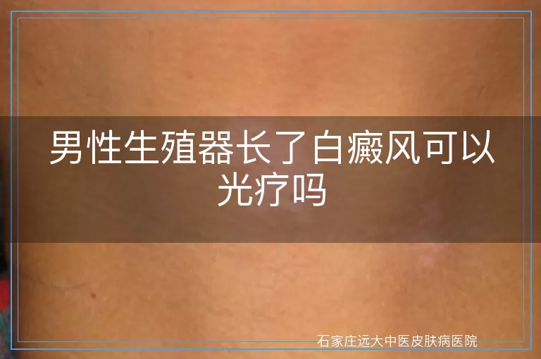 男性生殖器长了白癜风可以光疗吗