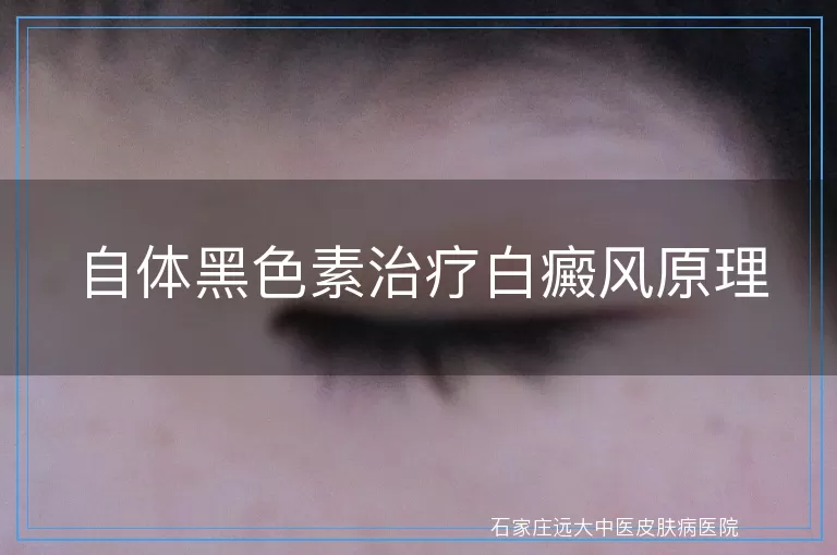 自体黑色素治疗白癜风原理