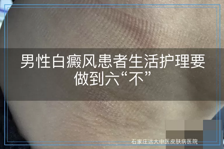 男性白癜风患者生活护理要做到六“不”