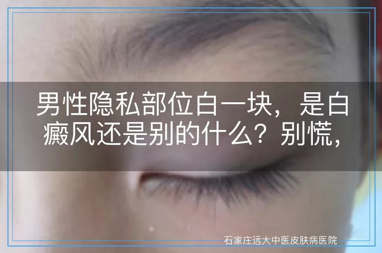 男性隐私部位白一块，是白癜风还是别的什么？别慌，咱们来聊聊
