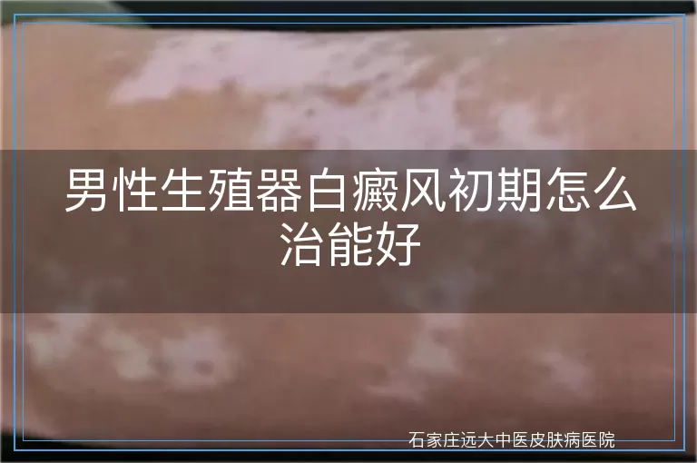 男性生殖器白癜风初期怎么治能好