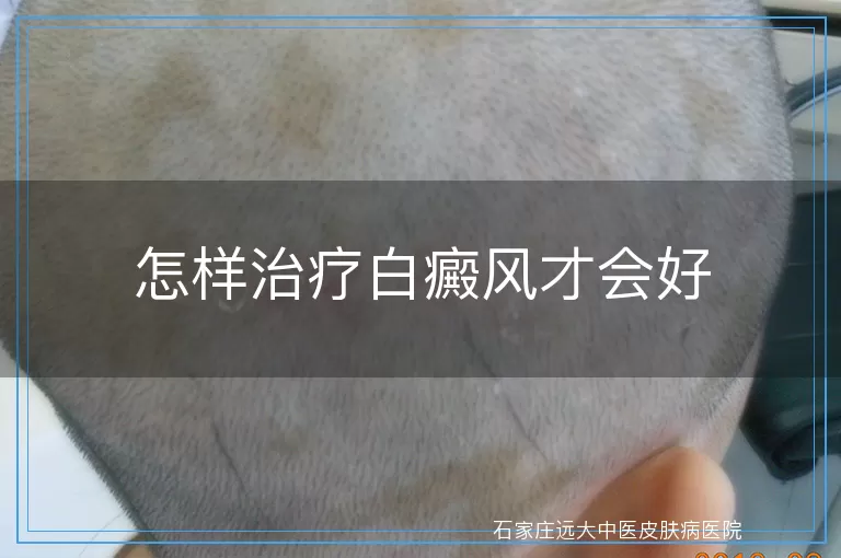 怎样治疗白癜风才会好