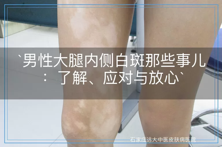 男性大腿内侧白斑那些事儿：了解、应对与放心