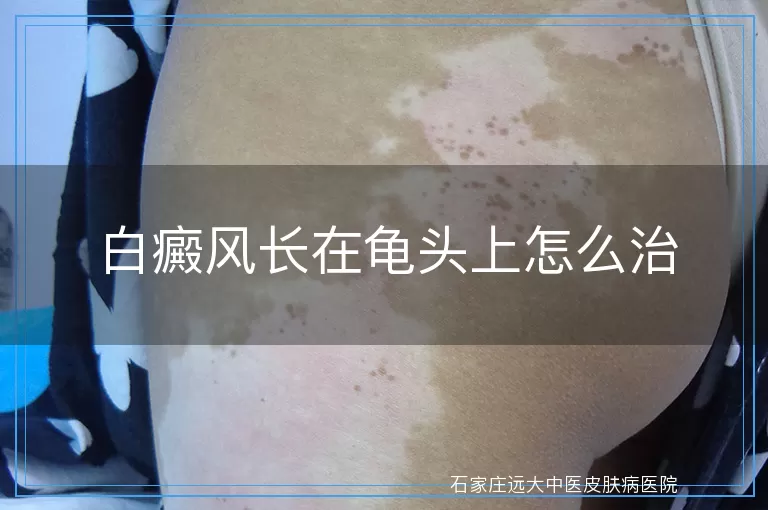 白癜风长在龟头上怎么治