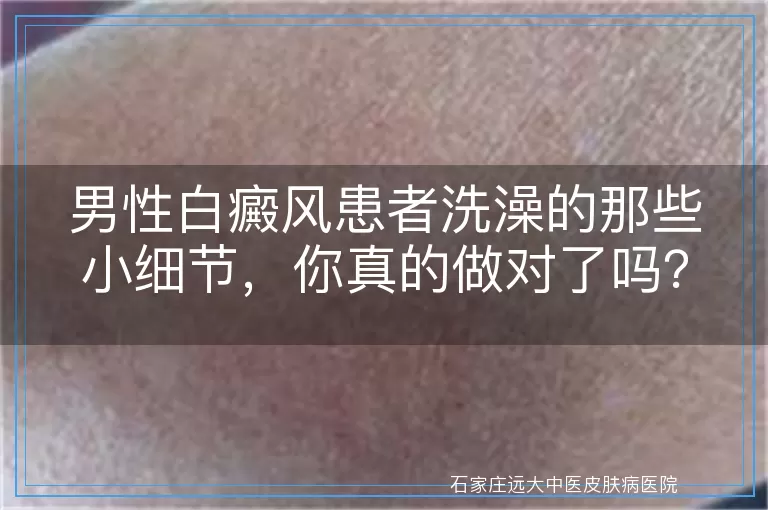 男性白癜风患者洗澡的那些小细节，你真的做对了吗？