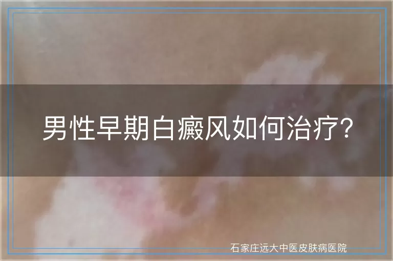 男性早期白癜风如何治疗？