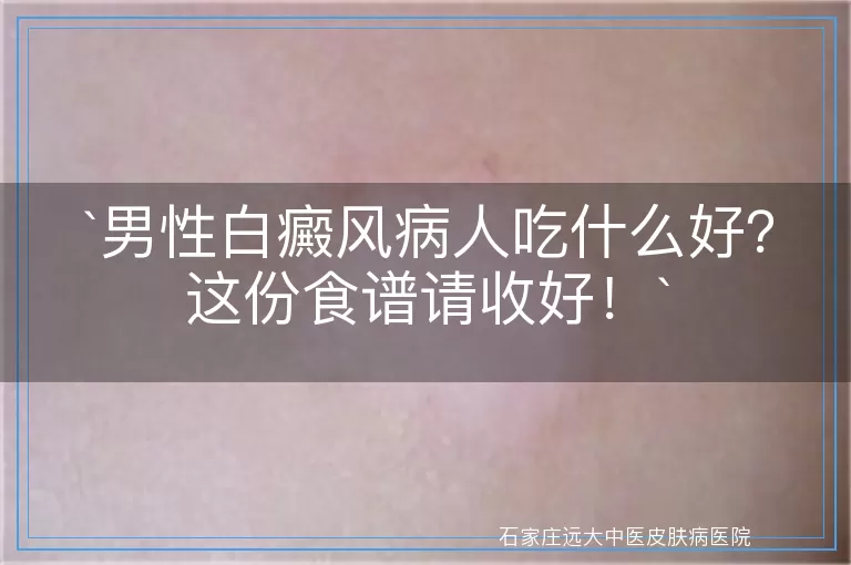 男性白癜风病人吃什么好？这份食谱请收好！