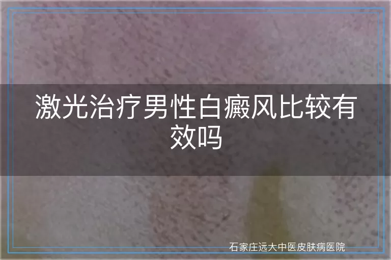 激光治疗男性白癜风比较有效吗