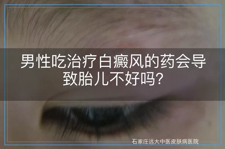 男性吃治疗白癜风的药会导致胎儿不好吗？