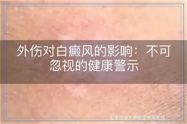 外伤对白癜风的影响：不可忽视的健康警示