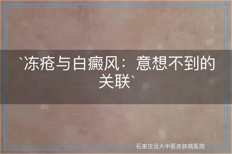 冻疮与白癜风：意想不到的关联