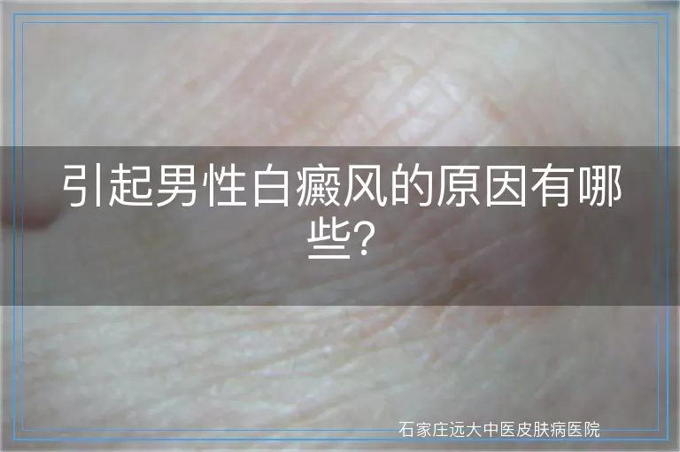 引起男性白癜风的原因有哪些？