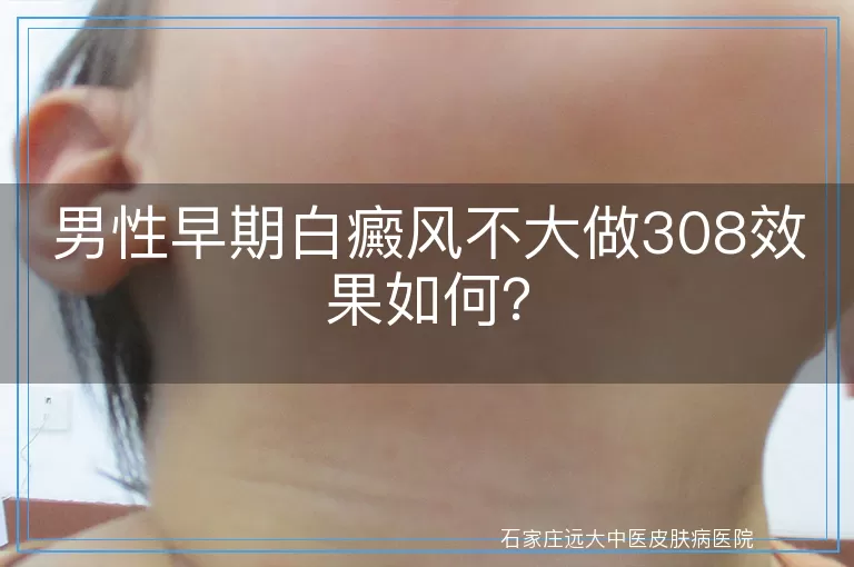 男性早期白癜风不大做308效果如何？