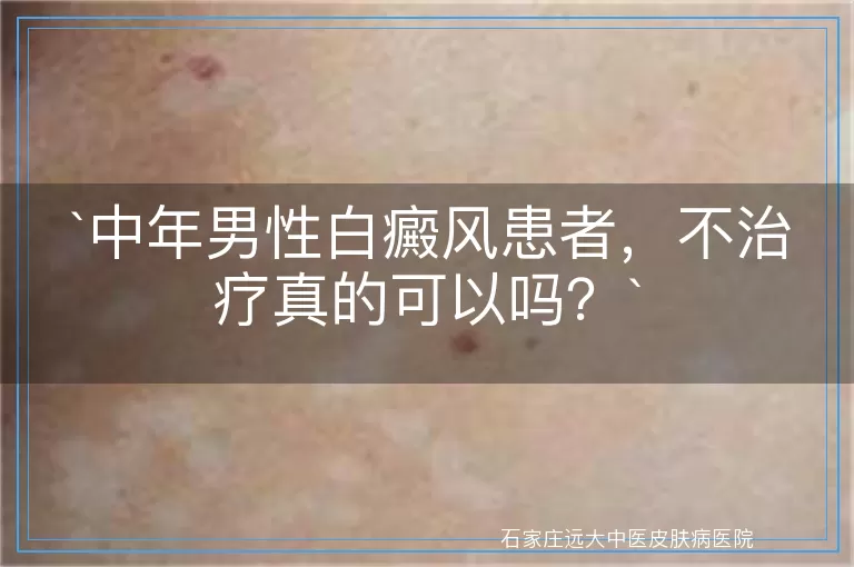 中年男性白癜风患者，不治疗真的可以吗？