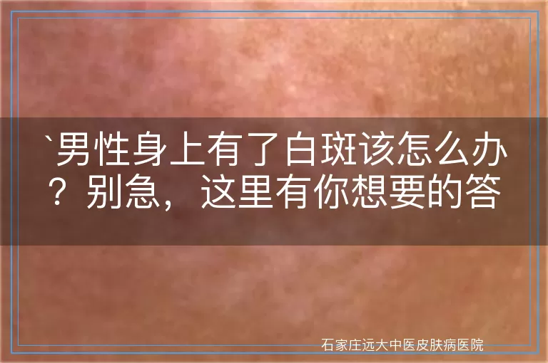 男性身上有了白斑该怎么办？别急，这里有你想要的答案！