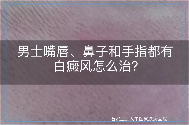 男士嘴唇、鼻子和手指都有白癜风怎么治？