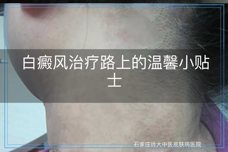 白癜风治疗路上的温馨小贴士