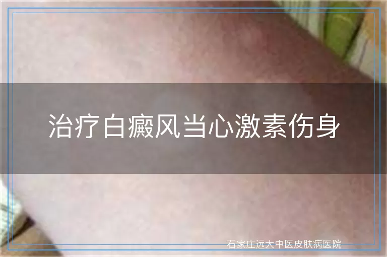 治疗白癜风当心激素伤身
