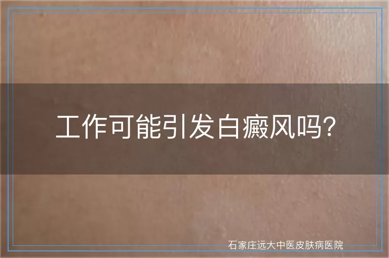 工作可能引发白癜风吗？