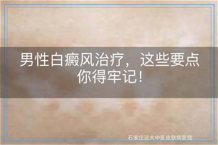 男性白癜风治疗，这些要点你得牢记！