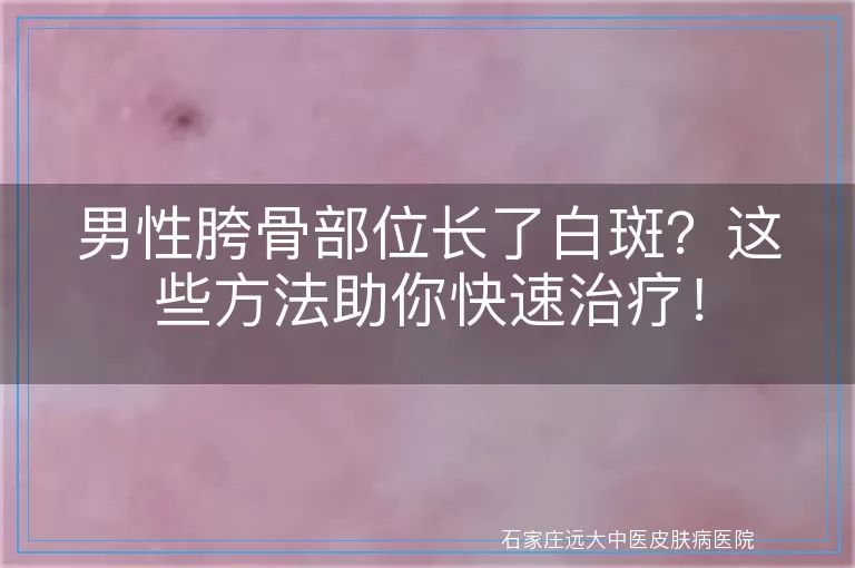 男性胯骨部位长了白斑?这些方法助你快速治疗!