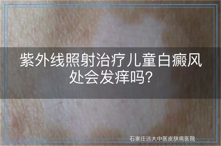紫外线照射治疗儿童白癜风处会发痒吗？