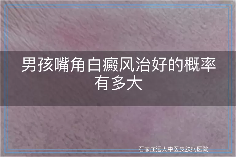 男孩嘴角白癜风治好的概率有多大