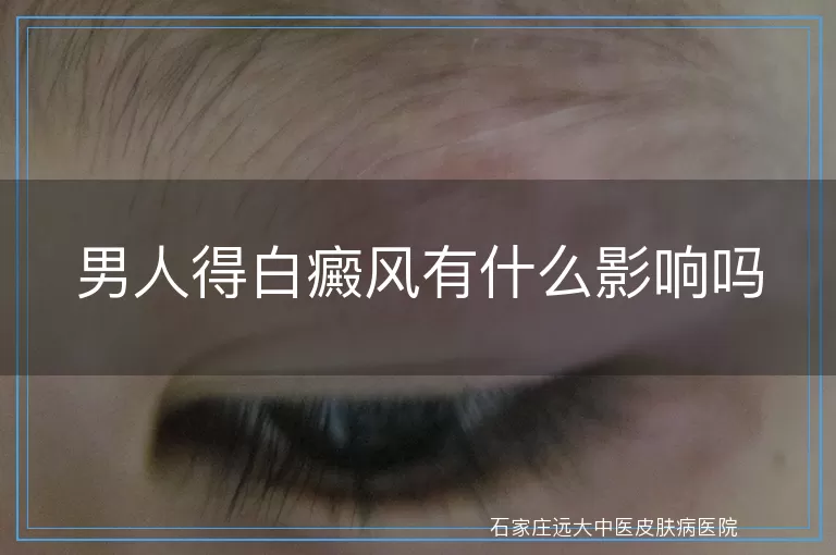 男人得白癜风有什么影响吗