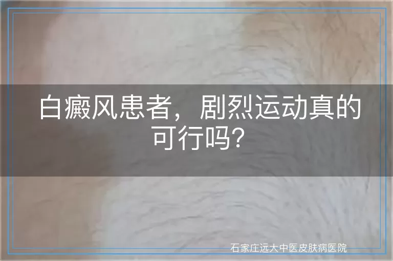 白癜风患者，剧烈运动真的可行吗？
