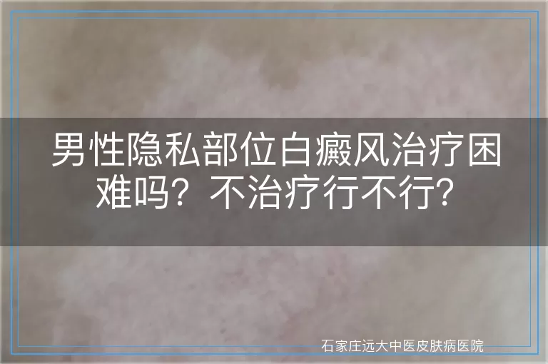 男性隐私部位白癜风治疗困难吗?不治疗行不行?