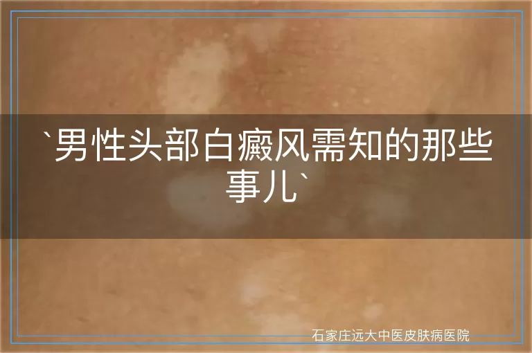 男性头部白癜风需知的那些事儿
