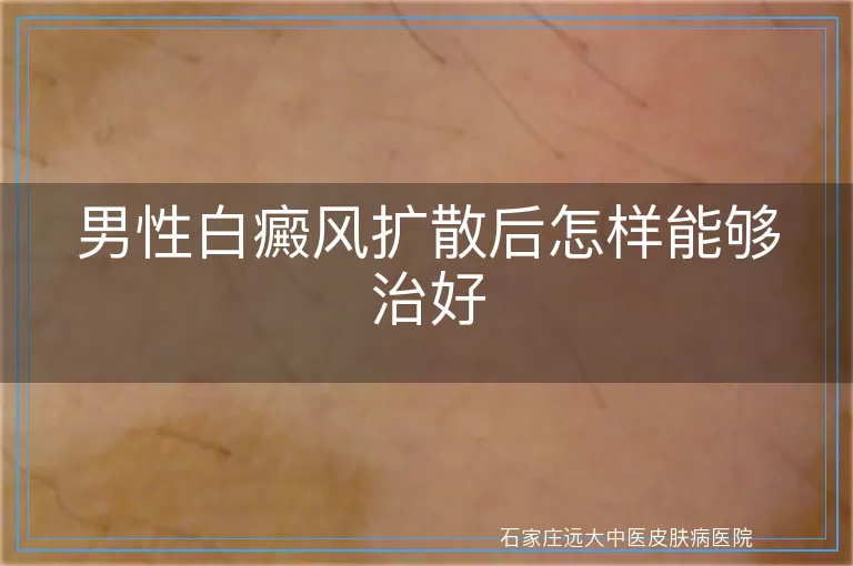 男性白癜风扩散后怎样能够治好