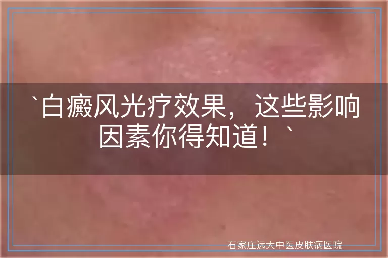 白癜风光疗效果，这些影响因素你得知道！