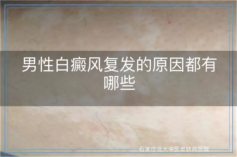 男性白癜风复发的原因都有哪些