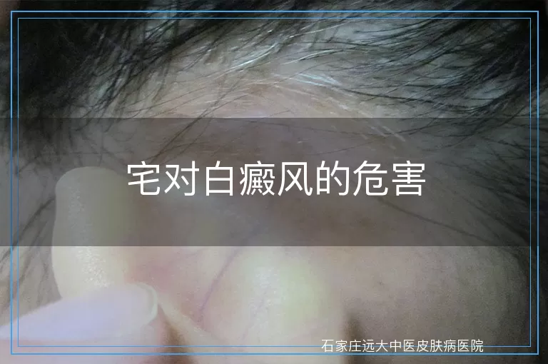 宅对白癜风的危害
