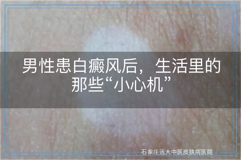男性患白癜风后，生活里的那些“小心机”