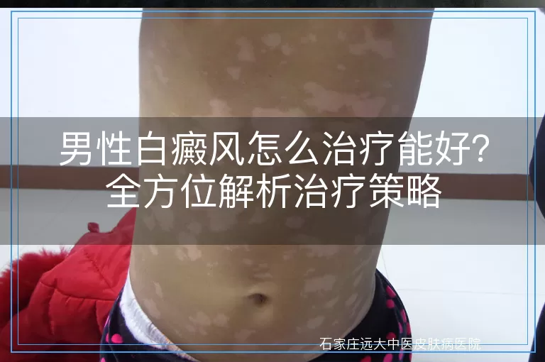 男性白癜风怎么治疗能好？全方位解析治疗策略